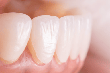 Dental Veneers - Fix Chipped, Gapped, or Misshapen Teeth