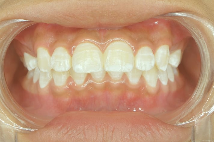 What Are the Lines on the Front of My Teeth? - Sure Dental