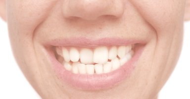 Crooked Teeth: Causes, Risks, and Treatment
