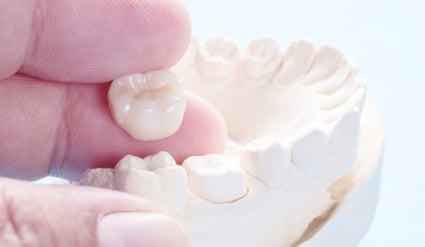 Dental Crowns: Everything You Need To Know