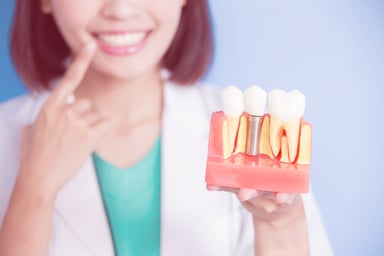 Dental Implants - 7 Common Questions Answered