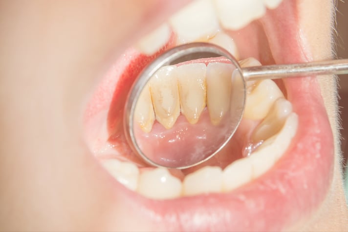 Dental Tartar (Calculus) - Causes, Prevention and Removal