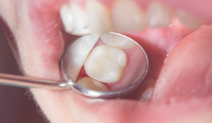 Fillings vs Onlays: Making the Right Choice