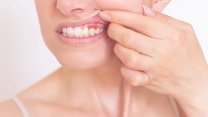 Periodontal Disease (Gum Disease): Everything You Need to Know