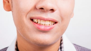 Causes of Tooth Discoloration and How to Prevent and Treat It