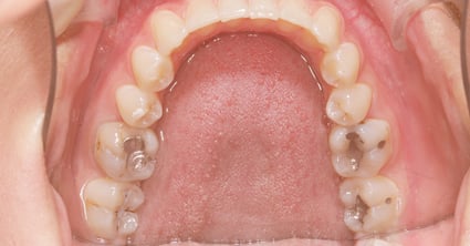 Why Amalgam Fillings Should Be Replaced With Resin Composite Fillings