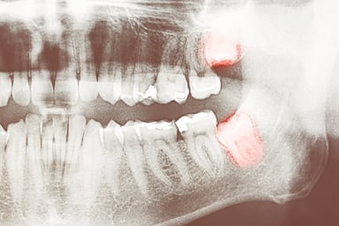Wisdom Teeth: When Do They Need To Be Removed?