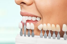Teeth Whitening or Dental Work? What Should Come First?