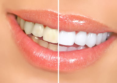 Achieve a Brighter Smile Faster With Professional Teeth Whitening